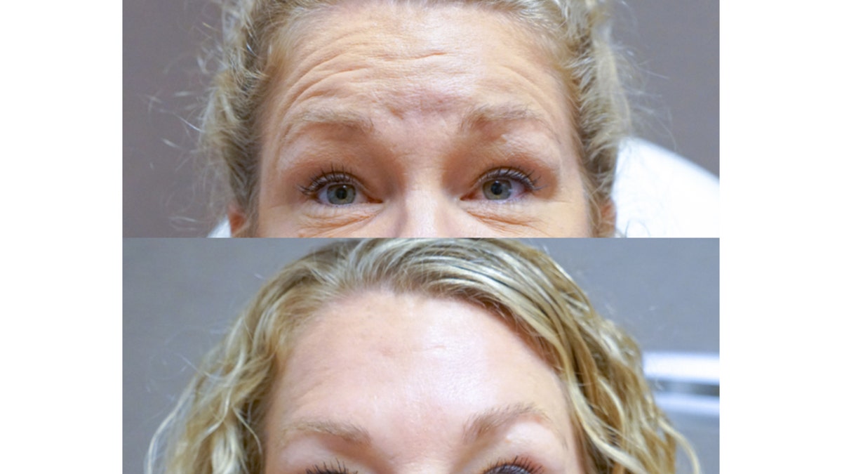 ‘Vegan Botox’ latest neurotoxin injectable among clients, patients